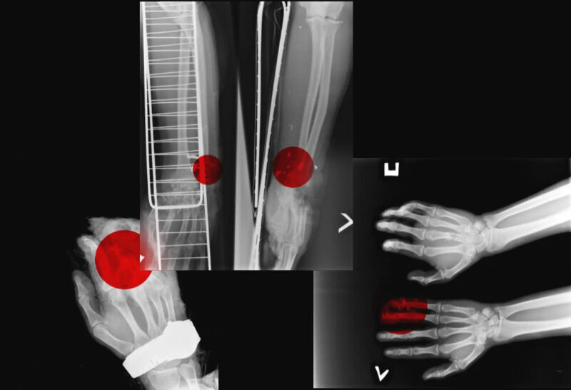 X-rays obtained by CNN